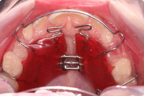 Aparelhos Ortopédicos
