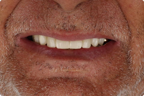 Implantes Dentários e Próteses Sobre Implantes
